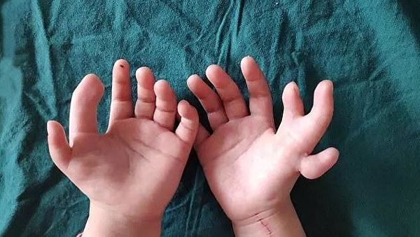 Çində 14 barmağı olan uşaq əməliyyat olundu