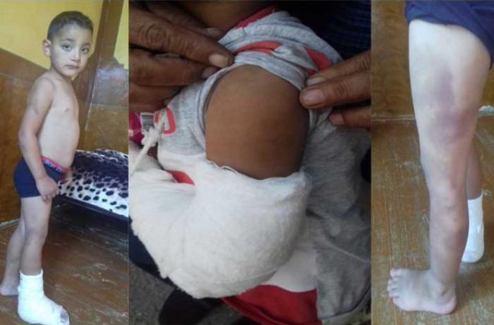 “Qardaşımın əlini deşib duzlu suya basırdı…” – İşgəncə verilən uşaqlar dəhşətləri danışdı