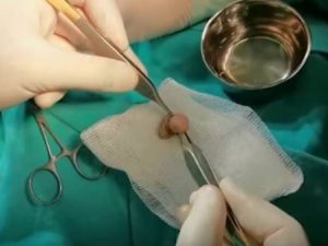 Sünnət zamanı uşağın cinsiyyət üzvünü dibindən kəsdilər: Səhiyyəmizin günü + VİDEO