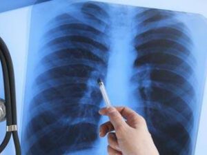 Gizli pnevmoniyanın ilk 6 əlaməti – Dərhal həkimə müraciət edin