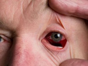 Yeni dəhşətli virus yayılır: 300 nəfər yoluxub – Gözlər yanır və…