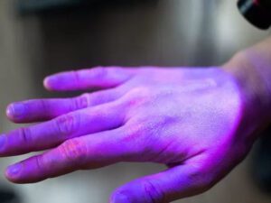 Koronavirusdan sağalanlarda rast gəlinən nadir hadisə