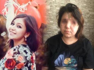 Gəncə terrorunda 2 gözünü itirən Pərvin… – FOTO