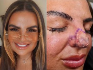 Daha gözəl görünmək istəyən qadın burnunu və dodağını itirmə təhlükəsi ilə üzləşdi – FOTO